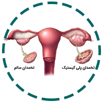 سندروم تخمدان پلی کیستیک