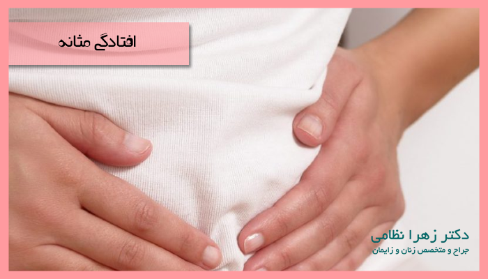 افتادگی مثانه