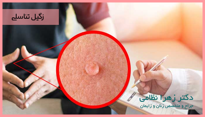 زگیل تناسلی