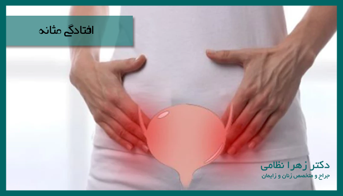 افتادگی مثانه