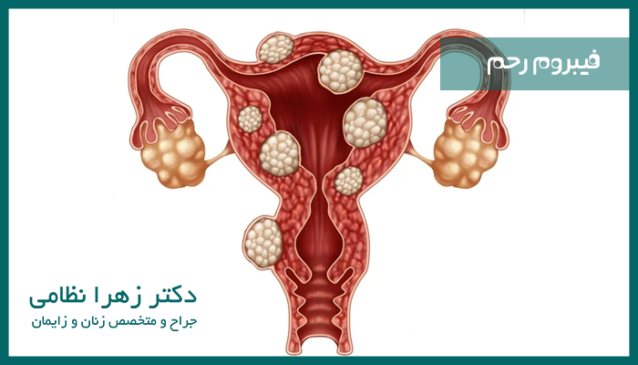 فیبروم رحم